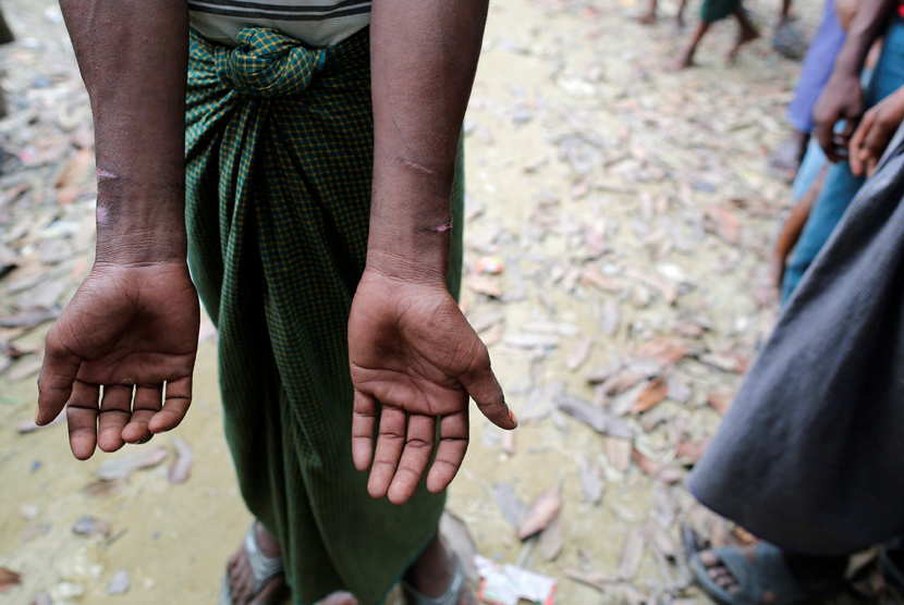 Etnis Rohingya ditangkap oleh tentara Myanmar dan kemudian dilepaskan, menunjukkan bekas luka di tangannya di sebuah Desa Rohingya. 