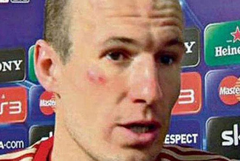 Foto Arjen Robben dengan wajah memar, setelah menang melawan Real Madrid di laga pertama semifinal Liga Champion, Rabu (18/4) 