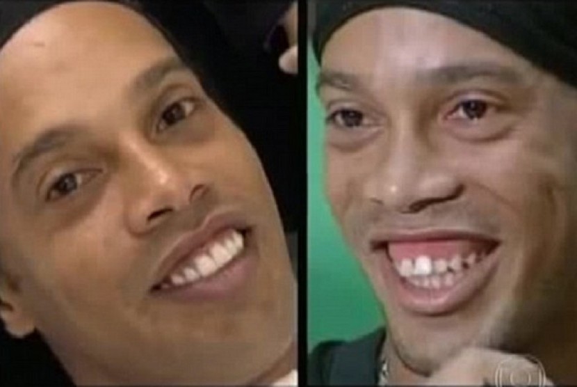 Foto Ronaldinho sebelum operasi (kanan) dan sesudah operasi gigi (kiri).
