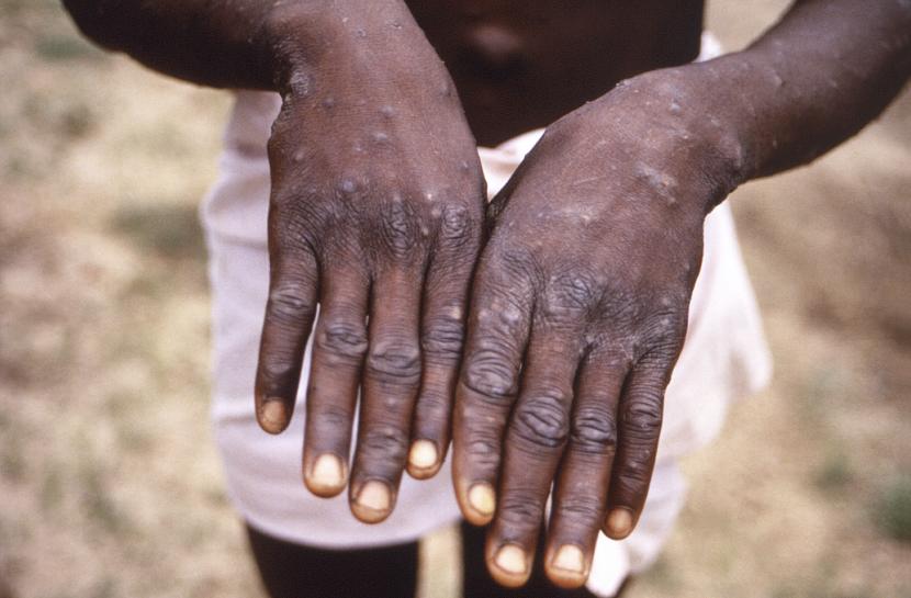 Foto yang dipasok CDC pada 1997 menunjukkan salah satu kasus cacar monyet di Republik Demokratik Kongo. Penyakit ini awalnya endemi di Afrika, namun kini telah ditemukan di 75 negara dengan tampilan klinis berbeda dari kasus-kasus terdahulu di Afrika..