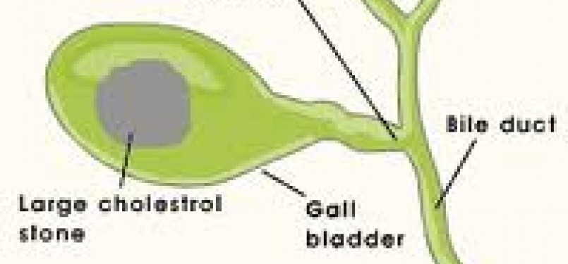 Gallbladder stone (graphic)