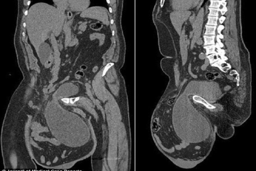 Hasil CT Scan hernia yang membesar hingga sebanding dengan ukuran bola sepak