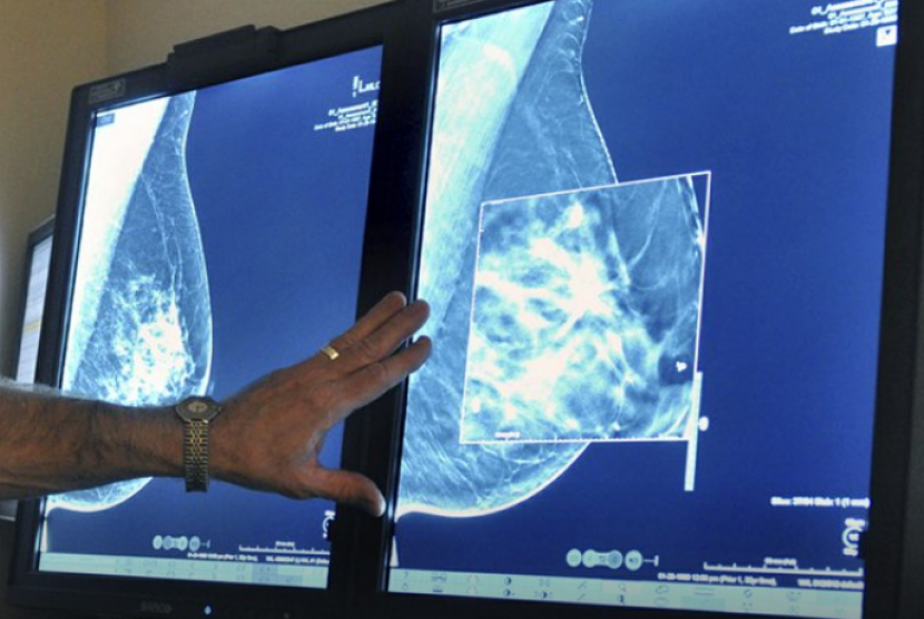 Risiko kanker payudara bisa dikurangi jika ditangani sejak awal. Ilustrasi kanker payudara
