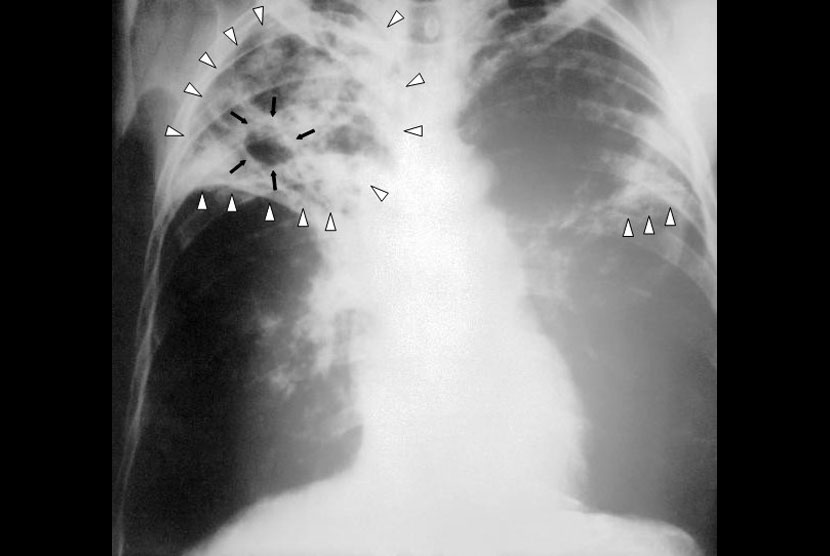 Hasil Sinar-X dada seorang penderita Tuberkulosis (TB) tingkat lanjut. Panah putih menunjukkan adanya infeksi pada kedua belah paru-paru. Panah hitam menunjukkan adanya lubang yang sudah terbentuk.