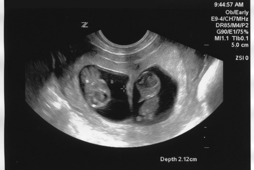 Hasil ultrasonografi yang memperlihatkan kehamilan kembar.
