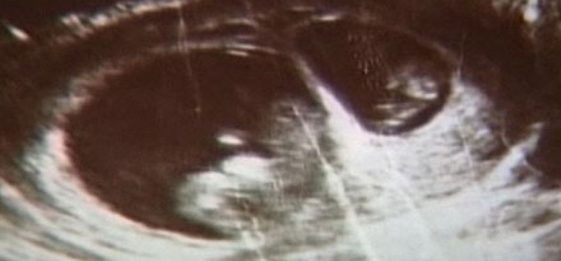 Hasil USG menunjukkan ada dua janin yang terpisah dalam rahim Julia Grovenburg. 
