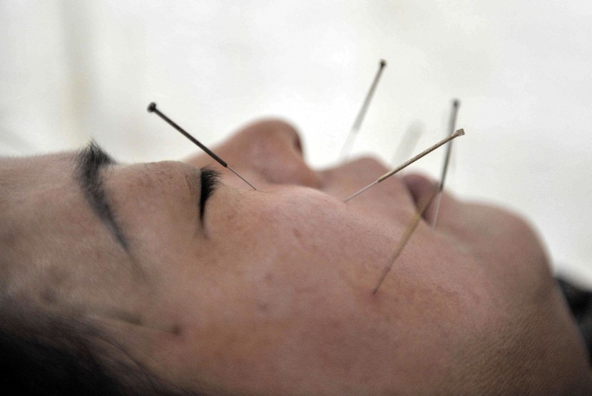Akupunktur kecantikan. Akupunktur dapat membuat wajah lebih cerah dan membantu mengatasi jerawat.