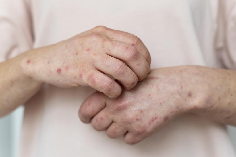 Ilustrasi alergi pada kulit. Pakar menyebutkan perbedaan bercak putih pada penyakit kusta dan panu.