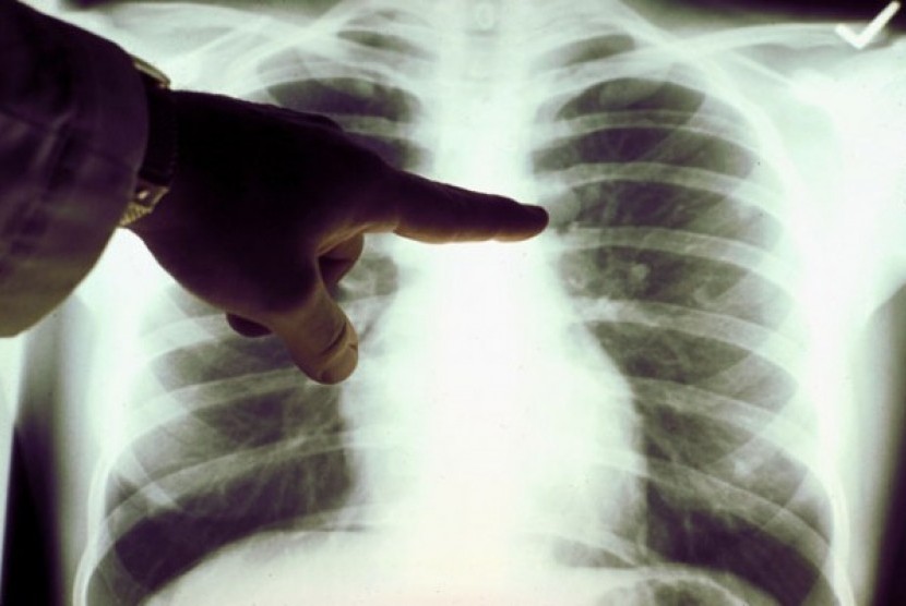 Ilustrasi kanker paru. Dengan kedokteran nuklir, perubahan anatomis pada paru terdeteksi dengan lebih baik.