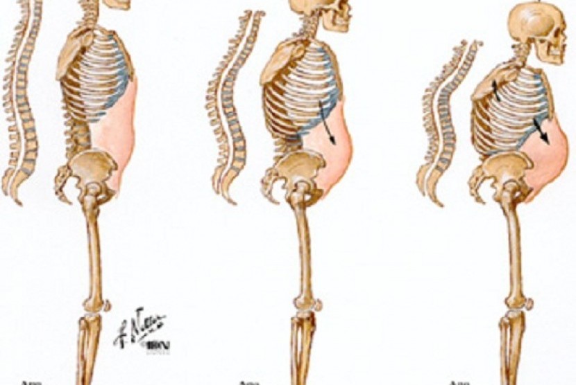 Menopause Bisa Sebabkan, Komplikasi Kesehatan, Apa Saja? Foto:   Ilustrasi osteoporosis.