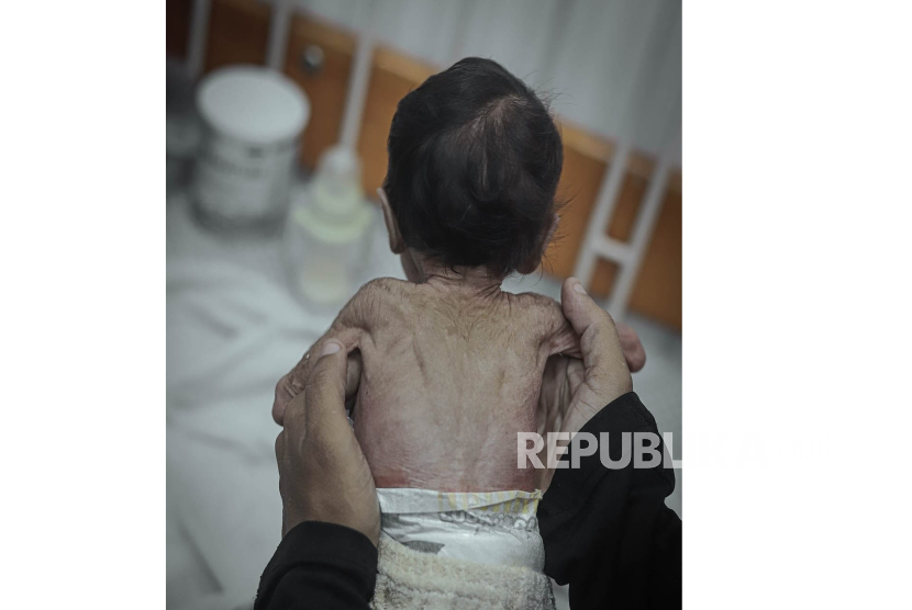 Ismail Halas (saat difoto usia 4 bulan), seorang bayi di Jalur Gaza, Palestina, mengalami malnutrisi akut. Blokade yang dilakukan militer Israel telah memicu krisis pangan sehingga ratusan orang kehilangan nyawa akibat kelaparan. Lebih dari 100 orang di antaranya adalah anak-anak.