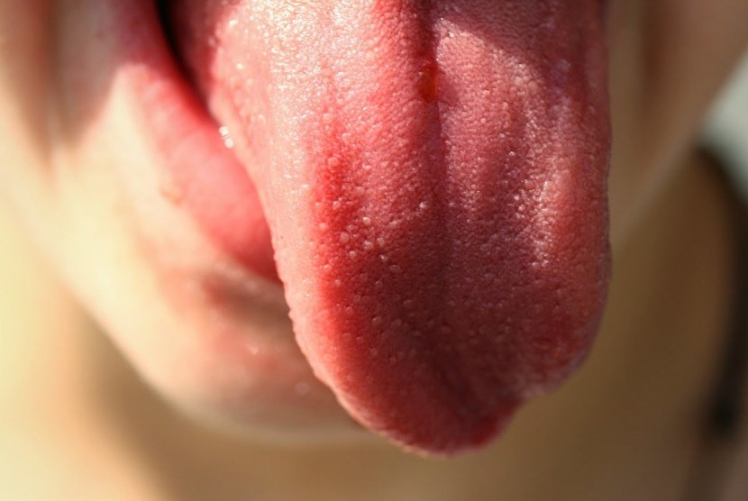 Pada anak sehat, lidah akan tampak memiliki bintil-bintil. Anak yang anemia berat lidahnya akan tampak mengkilap, hilang bintil-bintilnya.