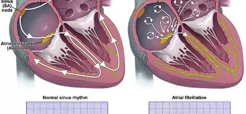 Jantung normal (kiri) dan Aritmia (kanan).