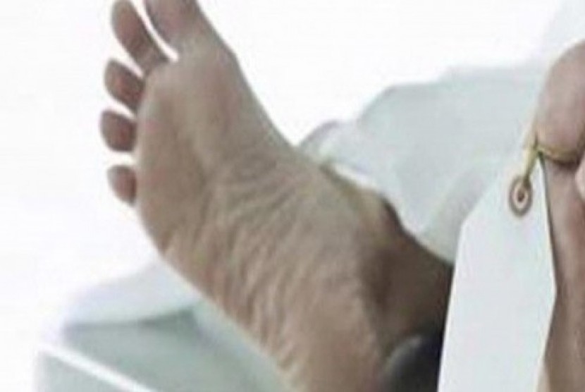 Potongan kaki (ilustrasi). Potongan kaki diduga limbah medis amputasi ditemukan di Bali. 