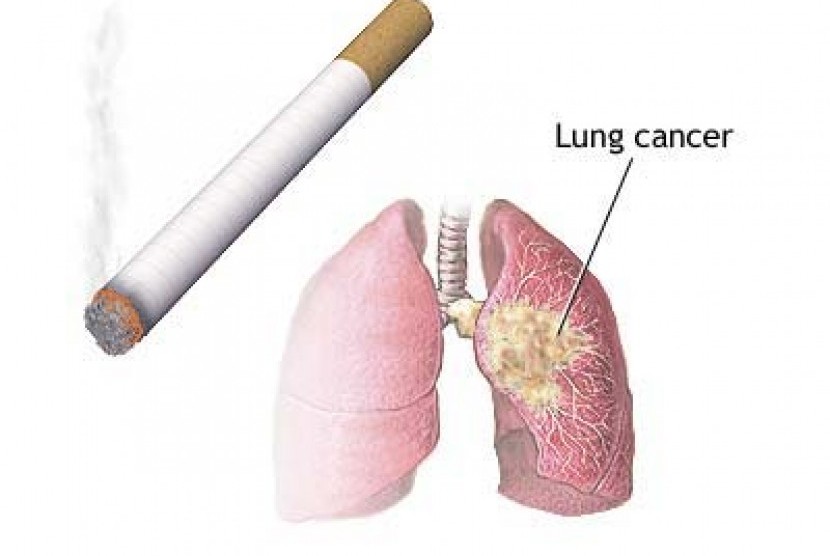 Kanker paru paru