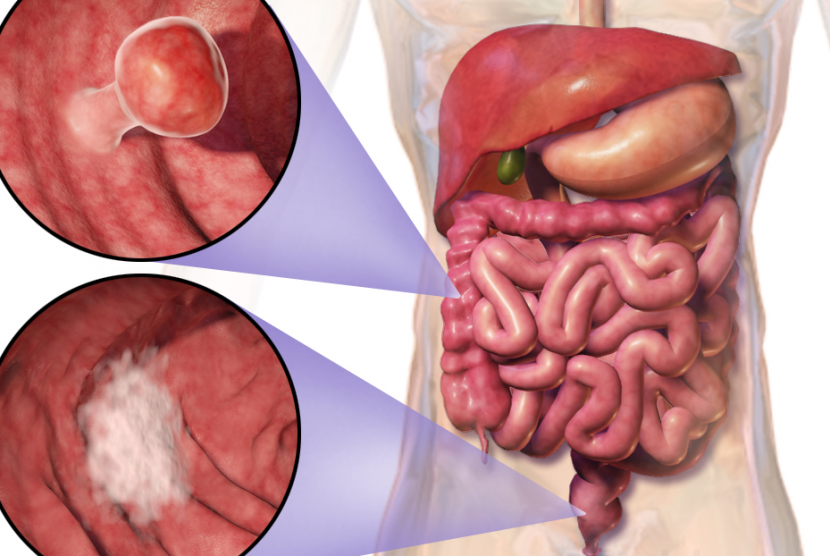 Dengan mengenali faktor risiko, kanker usus besar dapat dicegah sejak dini. Ilustrasi.