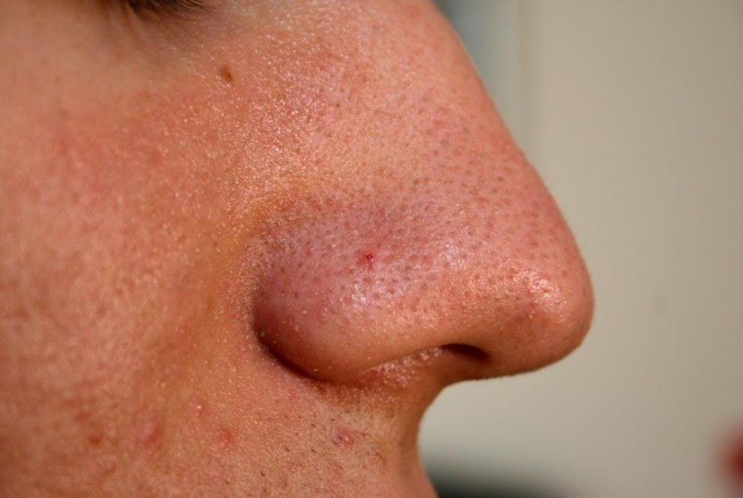 Kebiasaan mengorek hidung memiliki sejumlah dampak bagi kesehatan.
