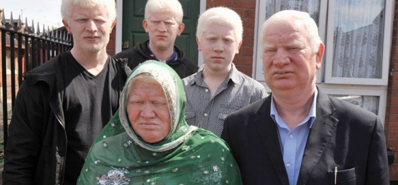 Keluarga Parvez, semua berkulit albino