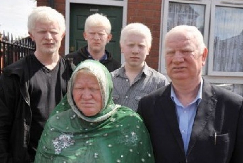 Keluarga Parvez, semua berkulit albino