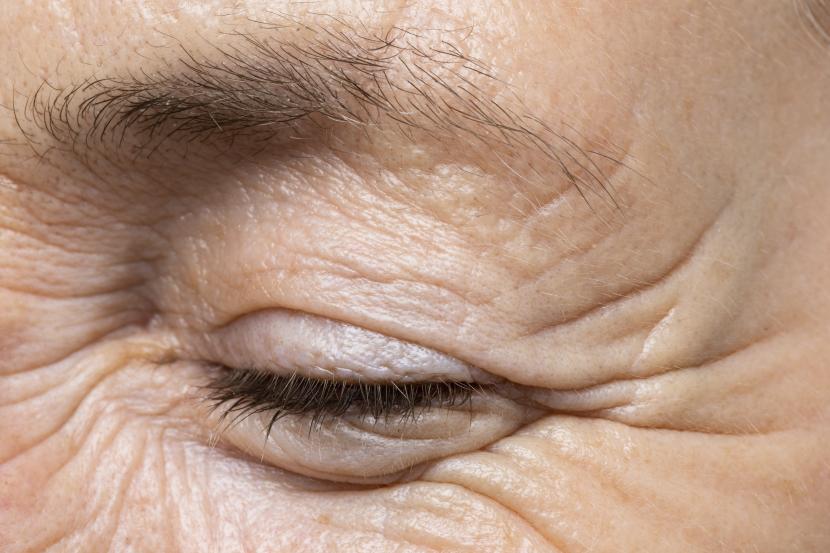 Keriput di wajah (ilustrasi). Keriput merupakan salah satu tanda penuaan. Ada beberapa penyebab seseorang terlihat lebih tua dari usia aslinya. 