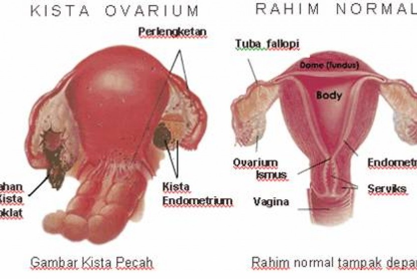 Ciri ciri kista ovarium