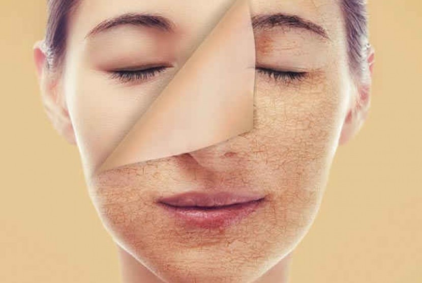 Kulit wajah kering dan terkelupas (ilustrasi). Risiko kulit kering akan semakin besar seiring dengan bertambahnya usia yang biasanya disebabkan oleh berkurangnya produksi kolagen, sebum, dan kadar air dalam kulit. 