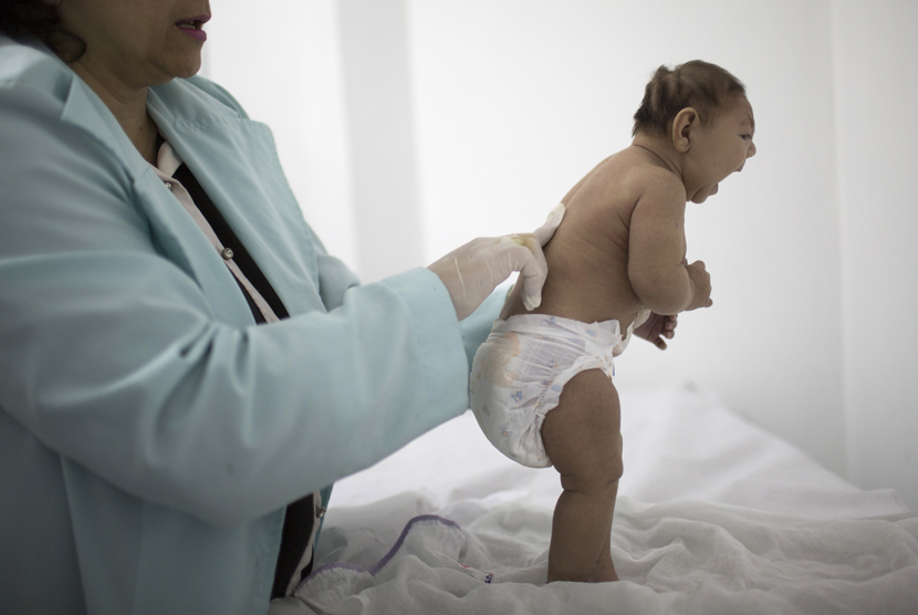 Lara berusia kurang dari tiga bulan terlahir dengan mikrosefalia yang terkena wabah virus zika di Brasil. 