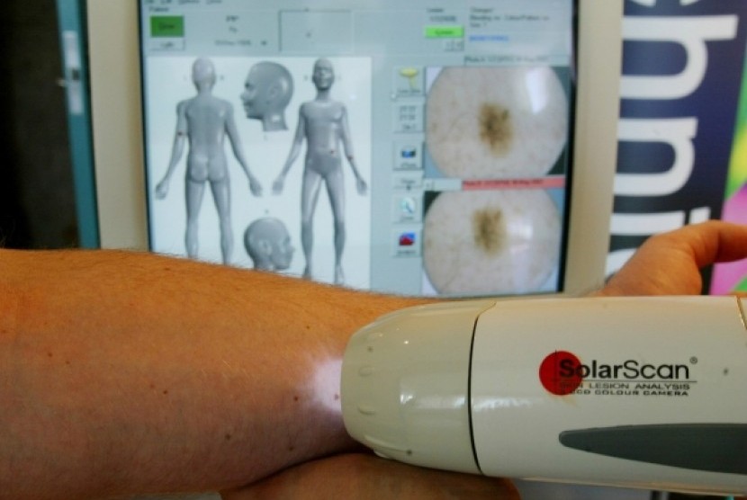 laser Doppler untuk mendeteksi kanker kulit