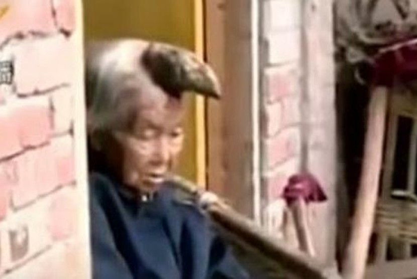 Liang Xiuzhen, nenek yang memiliki tanduk besar di kepalanya