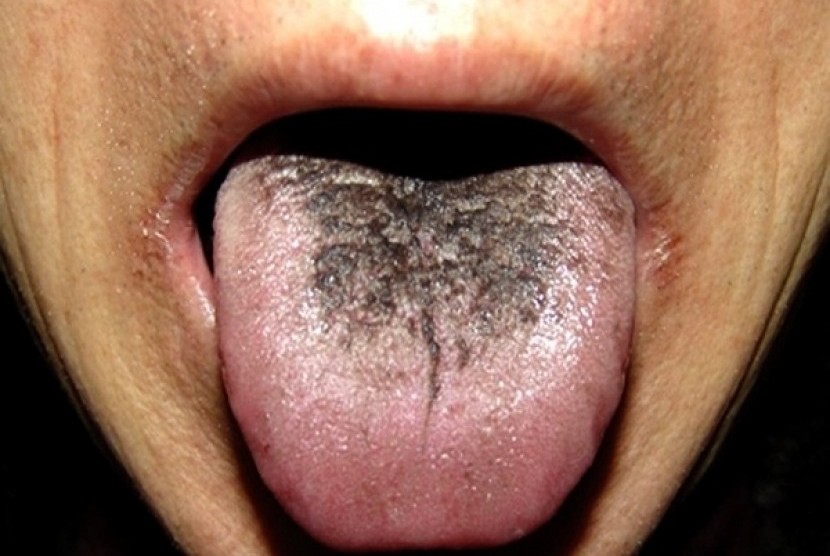 Bakteri di lidah bisa menyebabkan infeksi di jantung dan otak. (Ilustrasi)