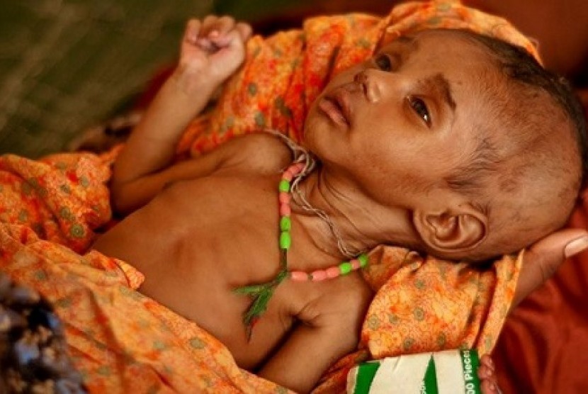Malnutrisi pada Anak
