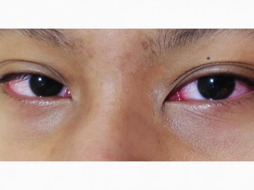 Mata merah. Para ahli menduga bahwa virus penyebab Covid-19 juga bisa masuk ke mata.  
