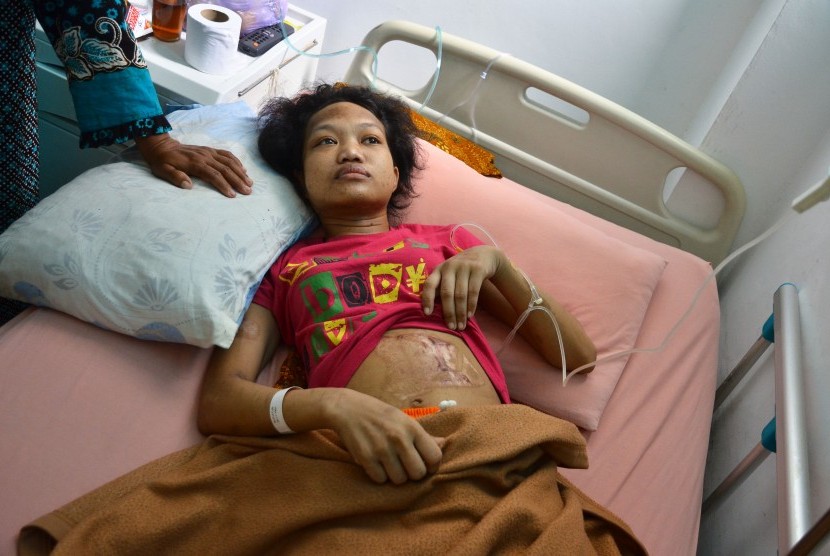 Mufiatun, seorang Pembantu Rumah Tangga (PRT) menunjukkan luka bekas Setrika di rumah sakit umum daerah (RSUD) dr Loekmono Hadi Kudus, Jawa Tengah, Senin (10/10).