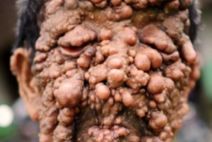 Neurofibromatosis (ilustrasi). Neurofibromatosis (NF) merupakan sekelompok penyakit genetik langka yang menyebabkan pertumbuhan tumor abnormal pada sistem saraf.