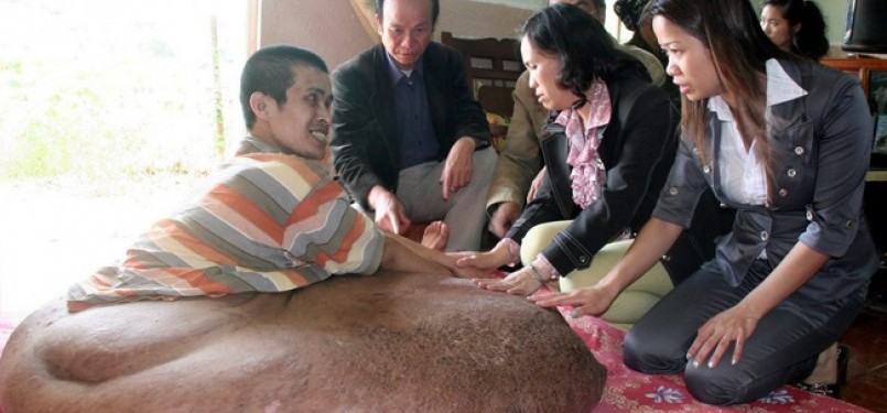 Nguyen Duy Hai mengidap tumor seberat 80 kilogram