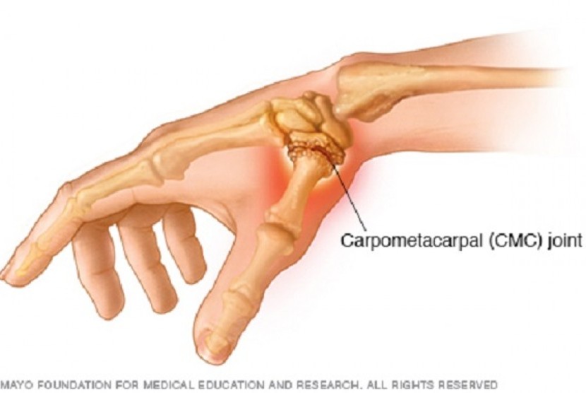 Osteoartritis sering mempengaruhi sendi-sendi yang menahan beban besar. Foto: Nyeri sendi ibu jari. Ilustrasi