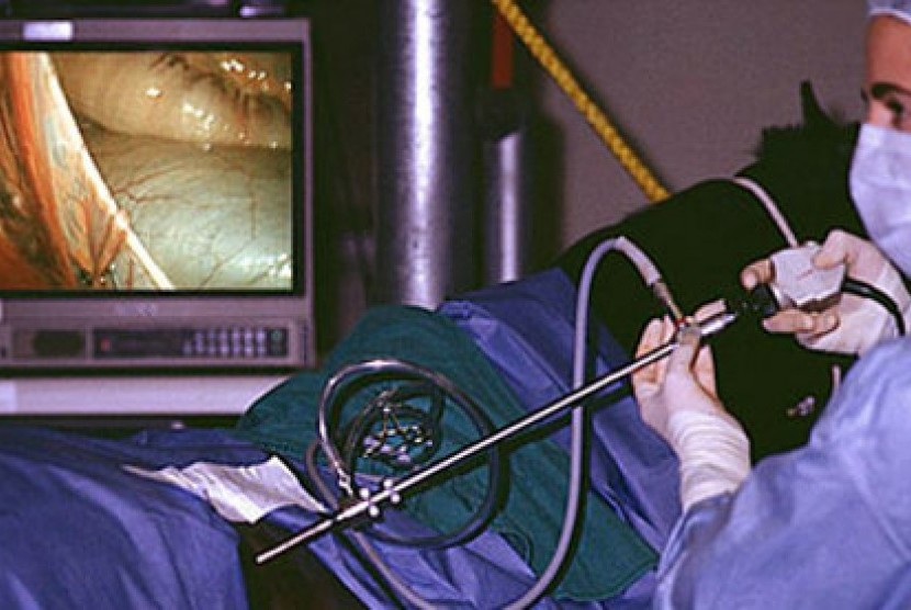 Operasi Laparoskopi (ilustrasi)