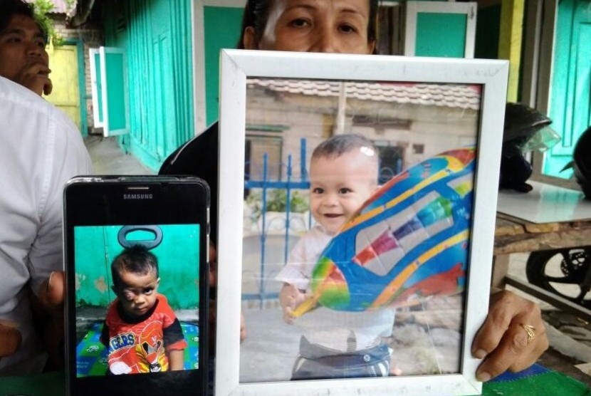 Orang tua Tri Ananda Syahputra menunjukkan foto anaknya sebelum (kanan) dan setelah terkena kanker mata.