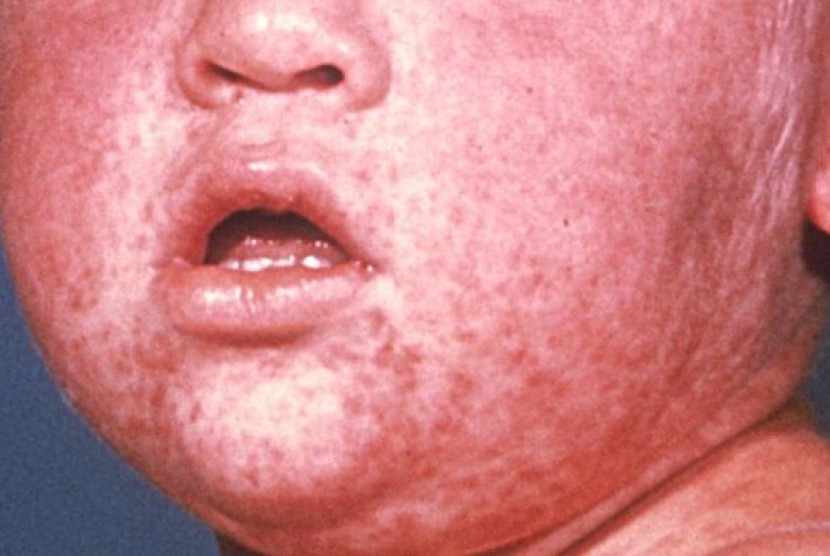 This child shows a classic day-4 with measles.