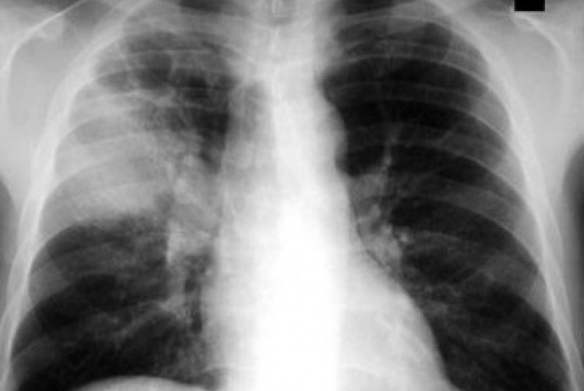Pasien paru PPOK bisa lebih buruk apabil terinfeksi Covid-19.