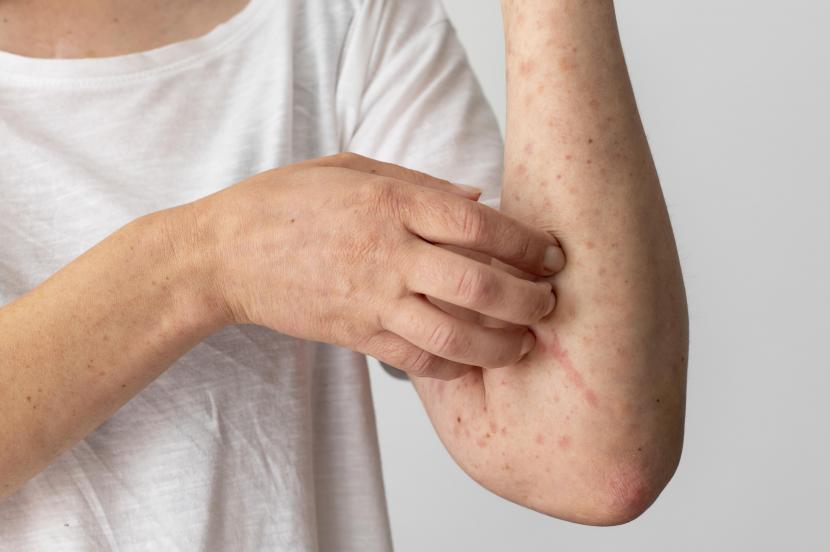 Enam kebiasaan yang bisa memperburuk kondisi kulit pada pasien psoriasis. (ilustrasi)