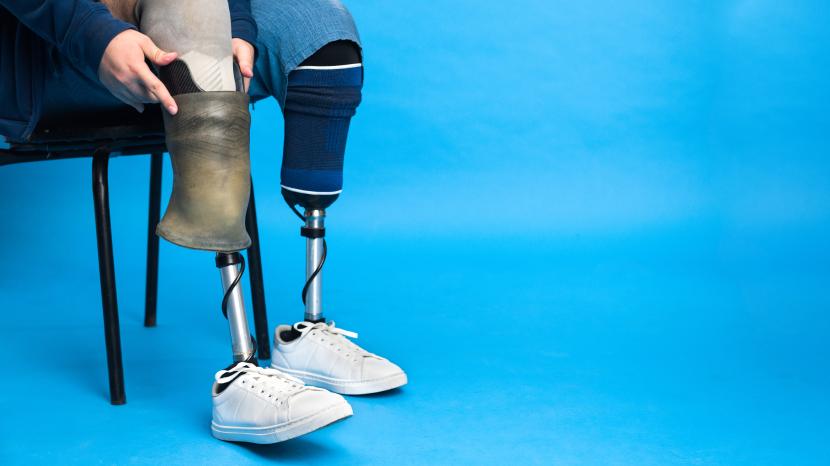 pasien diabetes mengalami amputasi kaki (ilustrasi). Berdasarkan penelitian, Penderita diabetes yang bercerai tampak lebih berisiko mengalami amputasi kaki.