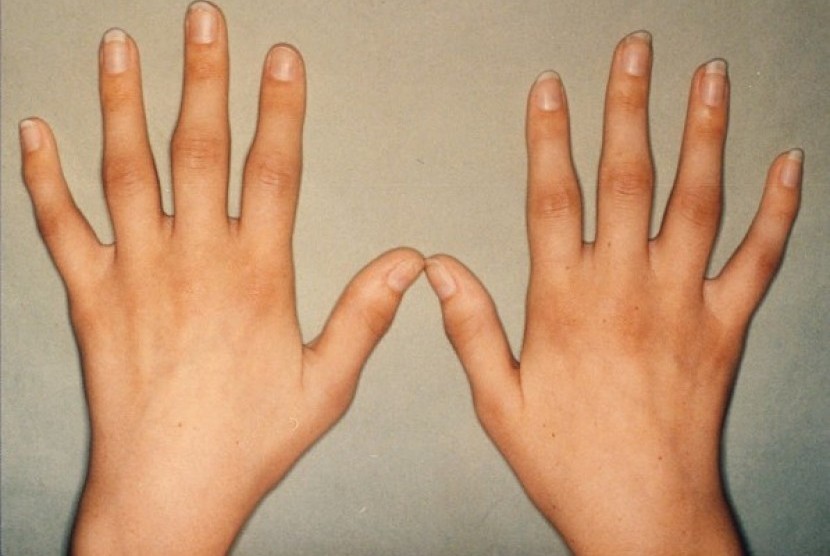 Pembengkakan pada persendian sebagai salah satu gejala dari artritis rematoid (AR).