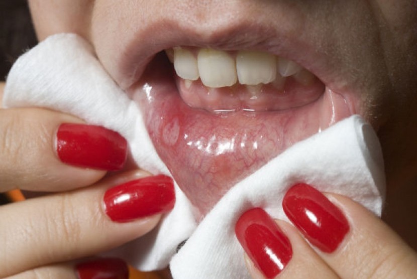 Pendarahan atau sariawan di mulut. Lima Tanda Anda Kekurangan Vitamin B12