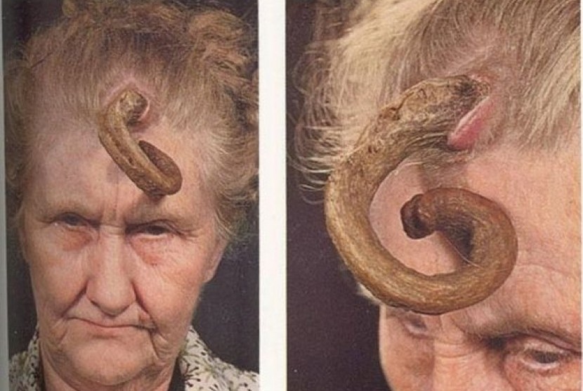 Penyakit Epidermodysplasia Verruciformis