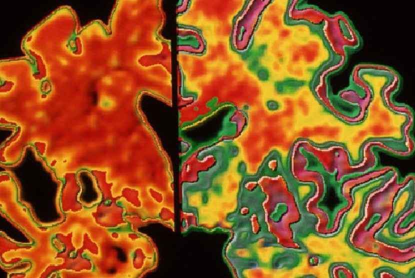 Perbandingan otak penderita Alzheimer (kiri) dengan otak normal (kanan)