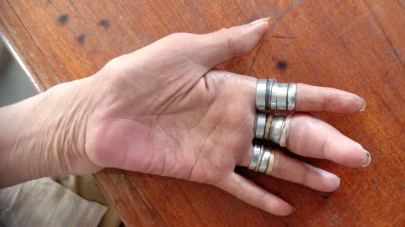 Petugas Damkar Jakarta Pusat sedang melepaskan 18 cincin yang membuat benkak jari kiri Rasid (60 tahun), pada Jumat (6/11) lalu.