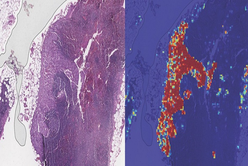 Program AI milik Google mengambil gambar mikroskopik nodus limfa (kiri) dan secara akurat mendeteksi tumor dengan tanda merah (kanan)