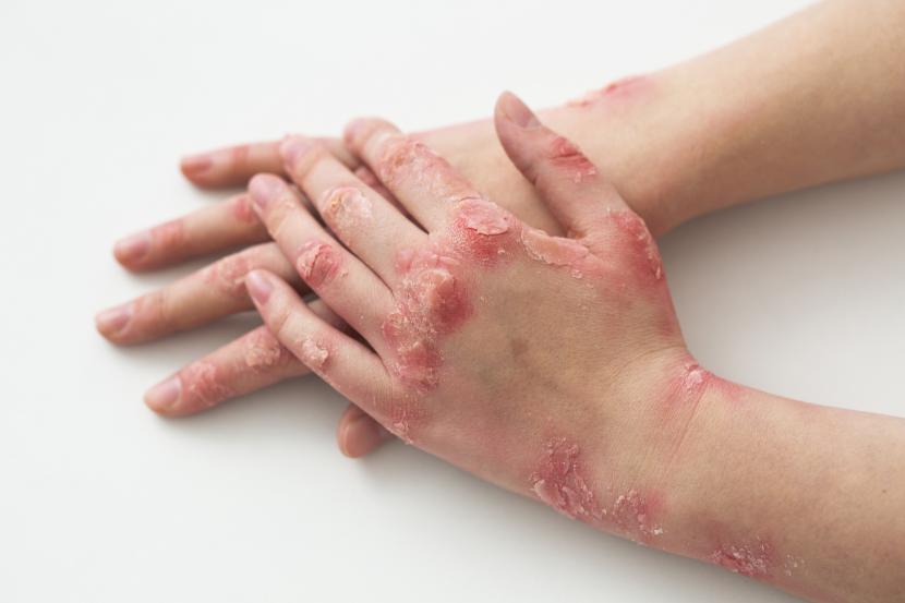 Seorang wanita mengalami luka bakar parah pada kulitnya setelah menggunakan krim steroid untuk mengobati eksimnya. (ilustrasi)