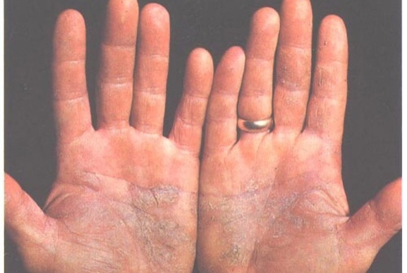 Telapak tangan yang mengalami psoriasis (Ilustrasi).
